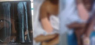 ഒമ്പത് വയസ്സുകാരിയുടെ കൈ മുറിച്ച് മാറ്റി; പിഴവ് പറ്റിയിട്ടില്ലെന്ന് പ്രാഥമിക അന്വേഷണ റിപ്പോർട്ട്