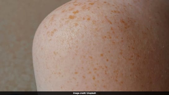 പൊതുജനങ്ങൾക്ക് ജാഗ്രതാ നിർദ്ദേശം, അഞ്ചാം പനി ബാധിച്ച യാത്രക്കാരൻ ന്യൂവാർക്ക് വിമാനത്താവളത്തിൽ എത്തി; വൈറസ് പടരാനുള്ള സാധ്യത