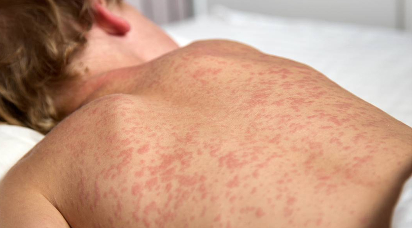 സൗത്ത് കരോലിനയില്‍ കൗമാരക്കാരില്‍ അഞ്ചാംപനി പടര്‍ന്നു പിടിക്കുന്നു: ക്ലെംസണ്‍ സര്‍വകലാശാലയിലെ വിദ്യാര്‍ഥികളിലും പടരുന്നു